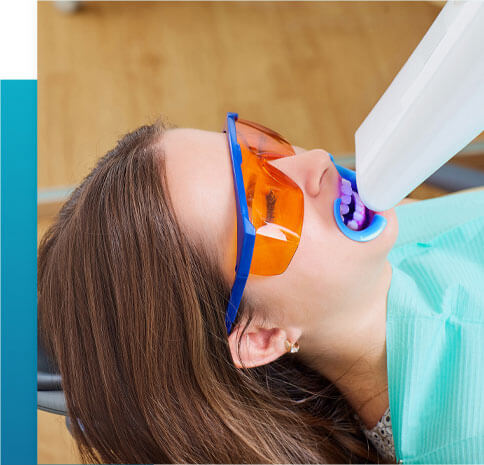 blanchiment dentaire