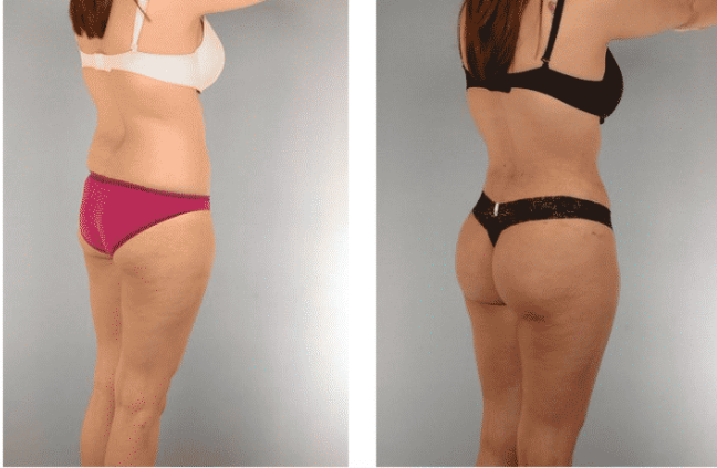 lipofilling fesses avant apres