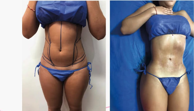 liposuccion vaser femme avant-après